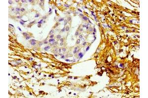 Immunohistochemistry of paraffin-embedded human breast cancer using ABIN7145679 at dilution of 1:100 (BMP1 anticorps  (AA 317-424))