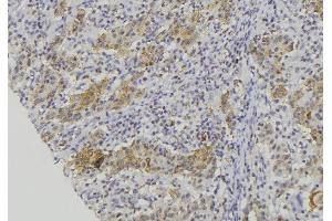 ABIN6279230 at 1/100 staining Human lung cancer tissue by IHC-P. (CALML5 anticorps  (Internal Region))