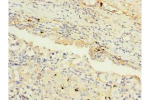 Immunohistochemistry of paraffin-embedded human lung cancer using ABIN7159277 at dilution of 1:100 (MAGEA9 anticorps  (AA 1-315))