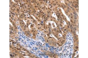 Immunohistochemistry of Human ovarian cancer using MAP2K1 Polyclonal Antibody at dilution of 1:25 (MEK1 anticorps)