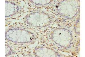 Immunohistochemistry of paraffin-embedded human colon cancer using ABIN7169603 at dilution of 1:100 (SEC11A anticorps  (Catalytic Subunit))