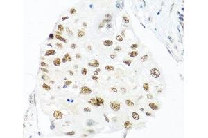 Immunohistochemistry of paraffin-embedded Human lung cancer using THOC1 Polyclonal Antibody at dilution of 1:100 (40x lens). (THOC1 anticorps)