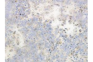 ABIN6262427 and ABIN6268846 at 1/100 staining human melanoma by IHC-P. (TANK anticorps  (Internal Region))