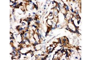 IHC-P: MEK1 antibody testing of human breast cancer tissue (MEK1 anticorps  (C-Term))