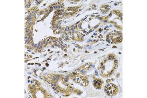 Immunohistochemistry of paraffin-embedded human breast cancer using DRD3 Antibody. (DRD3 anticorps)