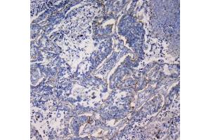 IHC testing of FFPE human lung cancer tissue with ITGA5 antibody at 1ug/ml.