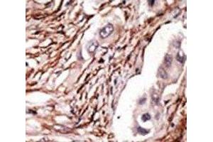 IHC analysis of FFPE human breast carcinoma tissue stained with the NOTCH3 antibody (NOTCH3 anticorps  (AA 2291-2321))