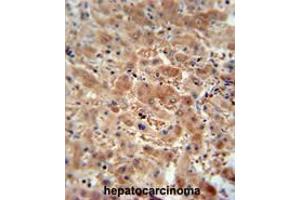 ASAP3 antibody (N-term) immunohistochemistry analysis in formalin fixed and paraffin embedded human hepatocarcinoma followed by peroxidase conjugation of the secondary antibody and DAB staining. (ASAP3 anticorps  (N-Term))