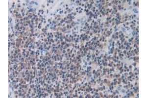 Detection of MX1 in Human Skin cancer Tissue using Polyclonal Antibody to Myxovirus Resistance 1 (MX1) (MX1 anticorps  (AA 80-342))