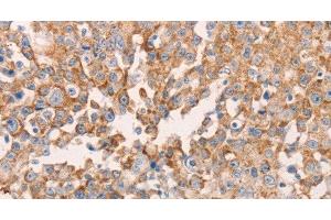 Immunohistochemistry of paraffin-embedded Human breast cancer using GNA11 Polyclonal Antibody at dilution of 1:40