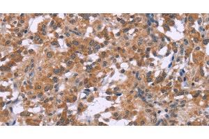 Immunohistochemistry of paraffin-embedded Human thyroid cancer tissue using GNPAT Polyclonal Antibody at dilution 1:40 (GNPAT anticorps)
