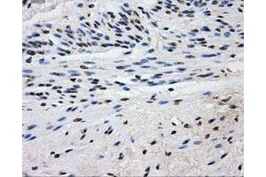Immunohistochemical staining of paraffin-embedded Carcinoma of liver tissue using anti-L1CAMmouse monoclonal antibody. (L1CAM anticorps)