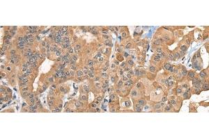 Immunohistochemistry of paraffin-embedded Human thyroid cancer tissue using BCAN Polyclonal Antibody at dilution of 1:35(x200) (BCAN anticorps)