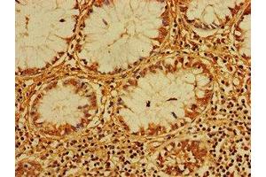 Immunohistochemistry of paraffin-embedded human colon cancer using ABIN7147455 at dilution of 1:100