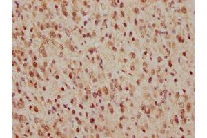 IHC image of ABIN7127412 diluted at 1:165 and staining in paraffin-embedded human glioma cancer performed on a Leica BondTM system.