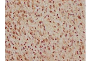 IHC image of ABIN7127412 diluted at 1:165 and staining in paraffin-embedded human glioma cancer performed on a Leica BondTM system. (Recombinant CDC25C anticorps)