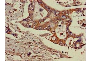 Immunohistochemistry of paraffin-embedded human pancreatic cancer using ABIN7143469 at dilution of 1:100