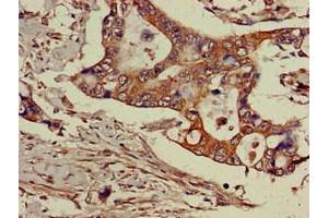 Immunohistochemistry of paraffin-embedded human pancreatic cancer using ABIN7143469 at dilution of 1:100 (GGA3 anticorps  (AA 342-503))