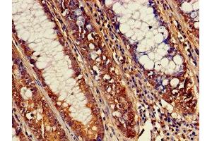 Immunohistochemistry of paraffin-embedded human colon cancer using ABIN7170052 at dilution of 1:100 (ATP1B3 anticorps  (AA 57-279))