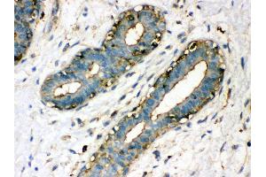 Anti- TGM2 Picoband antibody, IHC(P) IHC(P): Human Mammary Cancer Tissue