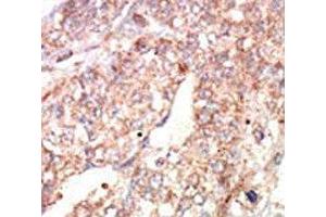 IHC analysis of FFPE human hepatocarcinoma tissue stained with the EphA1 antibody (EPHA1 anticorps  (AA 29-60))