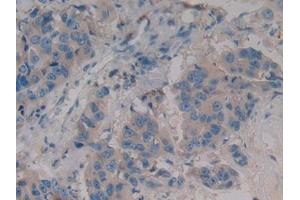 Detection of WNT3A in Human Breast cancer Tissue using Polyclonal Antibody to Wingless Type MMTV Integration Site Family, Member 3A (WNT3A)