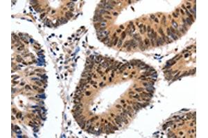 The image on the left is immunohistochemistry of paraffin-embedded Human colon cancer tissue using ABIN7190308(CMTM3 Antibody) at dilution 1/20, on the right is treated with synthetic peptide. (CMTM3 anticorps)