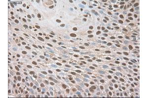 Immunohistochemical staining of paraffin-embedded Adenocarcinoma of breast using anti-Trim33 (ABIN2452535) mouse monoclonal antibody. (TRIM33 anticorps  (AA 887-1046))