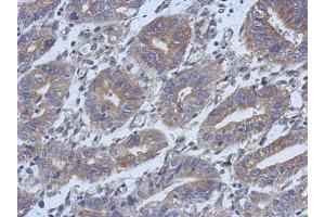 IHC-P Image Immunohistochemical analysis of paraffin-embedded human colon carcinoma, using C14orf94, antibody at 1:500 dilution. (C14orf94 anticorps)