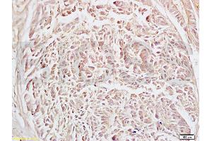 Formalin-fixed and human rectal carcinoma tissue labeled with Anti-Alpha-Adaptin Polyclonal Antibody, Unconjugated (ABIN673674) at 1:200 followed by conjugation to the secondary antibody and DAB staining