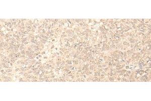 Immunohistochemistry of paraffin-embedded Human ovarian cancer tissue using PLEKHA1 Polyclonal Antibody at dilution of 1:30(x200)