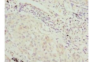 Immunohistochemistry of paraffin-embedded human lung cancer using ABIN7169217 at dilution of 1:100 (VRK1 anticorps  (AA 257-396))