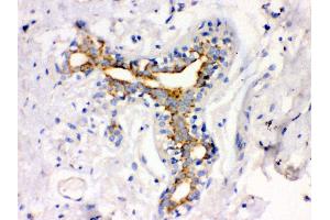 Anti- ATX2 Picoband antibody, IHC(P) IHC(P): Human Mammary Cancer Tissue (Ataxin 2 anticorps  (C-Term))