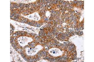 Immunohistochemistry of Human ovarian cancer using MAP2K5 Polyclonal Antibody at dilution of 1:40 (MAP2K5 anticorps)