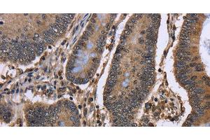 Immunohistochemistry of paraffin-embedded Human colon cancer using DCP1A Polyclonal Antibody at dilution of 1:50 (DCP1A anticorps)
