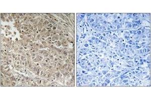 Immunohistochemistry analysis of paraffin-embedded human liver carcinoma tissue, using ABCC13 Antibody. (ABCC13 anticorps  (AA 56-105))