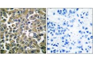 Immunohistochemistry analysis of paraffin-embedded human breast carcinoma tissue, using Keratin 16 Antibody. (KRT16 anticorps  (AA 421-470))