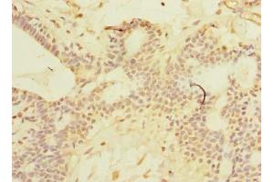 Immunohistochemistry of paraffin-embedded human breast cancer using ABIN7169911 at dilution of 1:100 (SCNM1 anticorps  (AA 1-230))