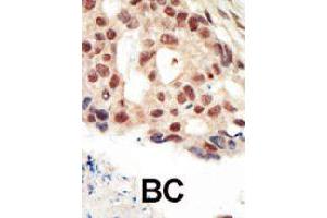 Formalin-fixed and paraffin-embedded human cancer tissue reacted with PRKG2 polyclonal antibody  , which was peroxidase-conjugated to the secondary antibody, followed by AEC staining.