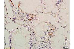 Formalin-fixed and paraffin embedded human colon carcinoma labeled with Anti-Phospho-CaMKII (Thr286) Polyclonal Antibody, Unconjugated (ABIN732473) at 1:200 followed by conjugation to the secondary antibody and DAB staining.