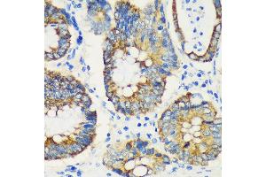 Immunohistochemistry of paraffin-embedded Human colon carcinoma using USP47 Rabbit pAb (ABIN7271166) at dilution of 1:100 (40x lens). (USP47 anticorps  (AA 1128-1287))