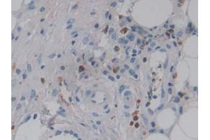 DAB staining on IHC-P; Samples: Human Skin cancer Tissue (CSF2RA anticorps  (AA 28-112))