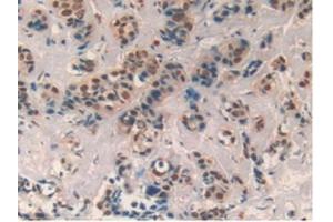 Detection of CXCL7 in Human Breast cancer Tissue using Polyclonal Antibody to Chemokine (C-X-C motif) ligand 7 ( CXCL7) (CXCL7 anticorps  (AA 59-128))