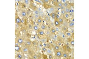 Immunohistochemistry of paraffin-embedded human liver injury using CHIA antibody (ABIN6292576) at dilution of 1:100 (40x lens). (CHIA anticorps)