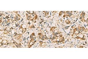 Immunohistochemistry of paraffin-embedded Human liver cancer tissue using VTA1 Polyclonal Antibody at dilution of 1:60(x200) (VTA1 anticorps)
