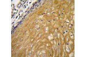 Immunohistochemistry analysis in human esophageal carcinoma (Formalin-fixed, Paraffin- embedded) using NUDT22  Antibody  (C-term), followed by peroxidase conjugation of the secondary antibody and DAB staining.