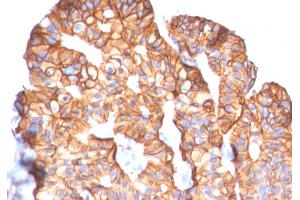Formalin-fixed, paraffin-embedded human Breast Carcinoma stained with HER-2 Mouse Monoclonal Antibody (ERBB2/2452). (ErbB2/Her2 anticorps  (AA 311-462))