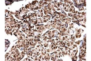 IHC-P Image MTA1 antibody [C1C3] detects MTA1 protein at nucleus on human breast carcinoma by immunohistochemical analysis. (MTA1 anticorps)