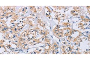 Immunohistochemistry of paraffin-embedded Human thyroid cancer tissue using CCR9 Polyclonal Antibody at dilution 1:60 (CCR9 anticorps)