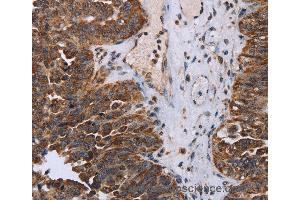 Immunohistochemistry of Human breast cancer using DDX11 Polyclonal Antibody at dilution of 1:30 (DDX11 anticorps)